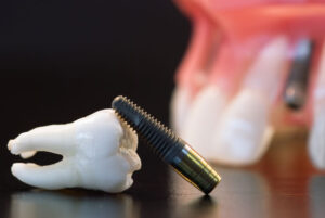 The image shows a dental implant next to a model of a human tooth or jawbone, commonly used in dental offices to demonstrate the function and placement of dental implants.